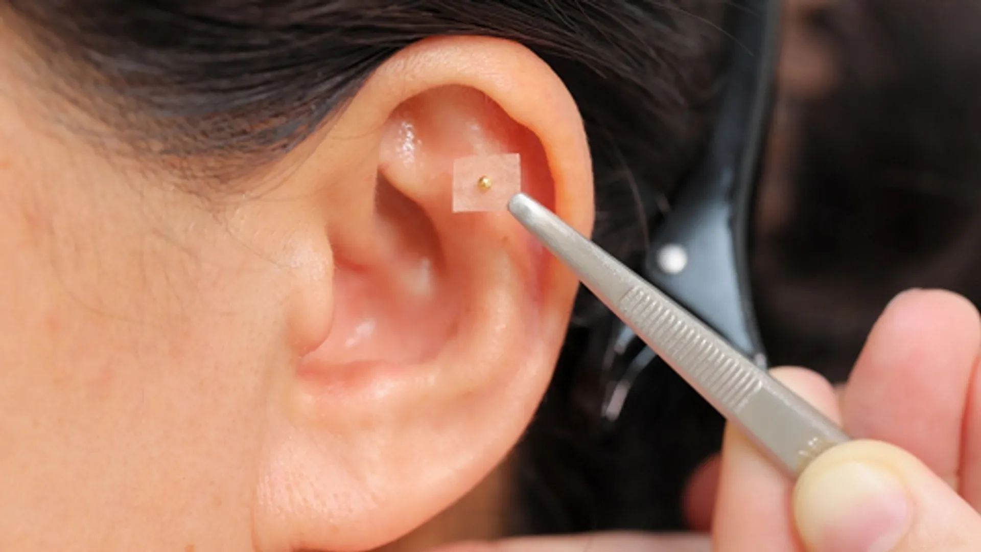 耳つぼ施術を受ける様子